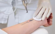 Eliminacin de tatuajes