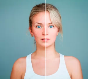 Tratamientos reducir manchas en la cara