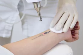 Eliminación de Tatuajes con Láser ND-YAG